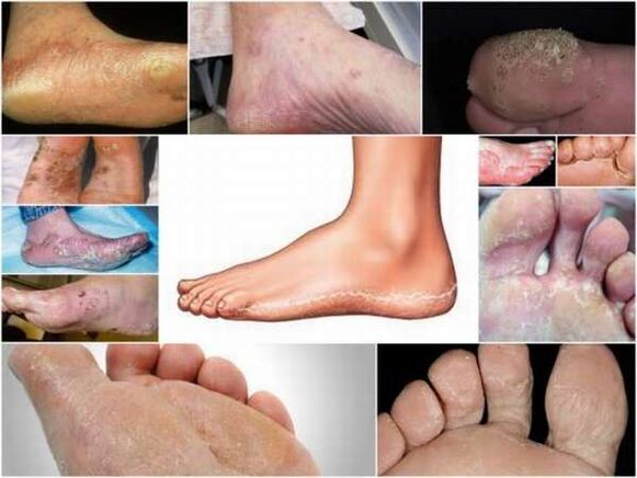 Ayak mikozunun skuamöz-hiperkeratotik formu