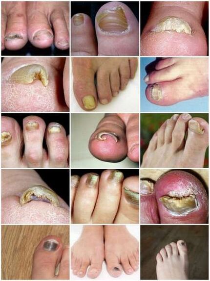 Ayak tırnağı plakasının mantar enfeksiyonu