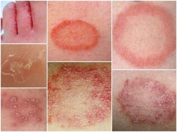 Bacak derisinin trikofitozu