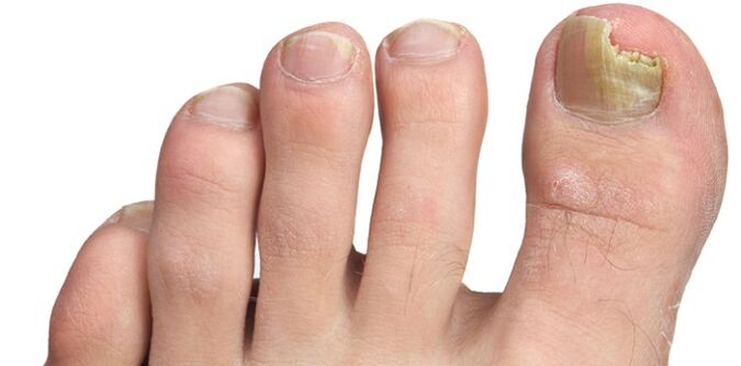 tırnak plağının mantar enfeksiyonu